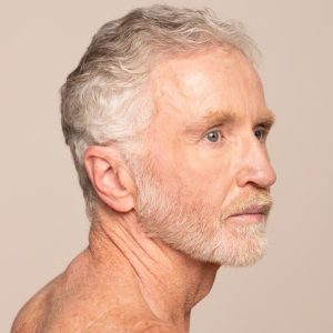IPL Photofacial