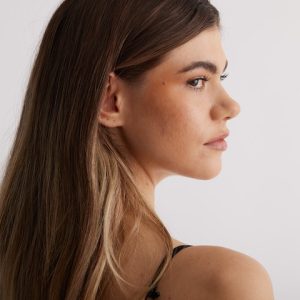 Chemical Peel Level 3